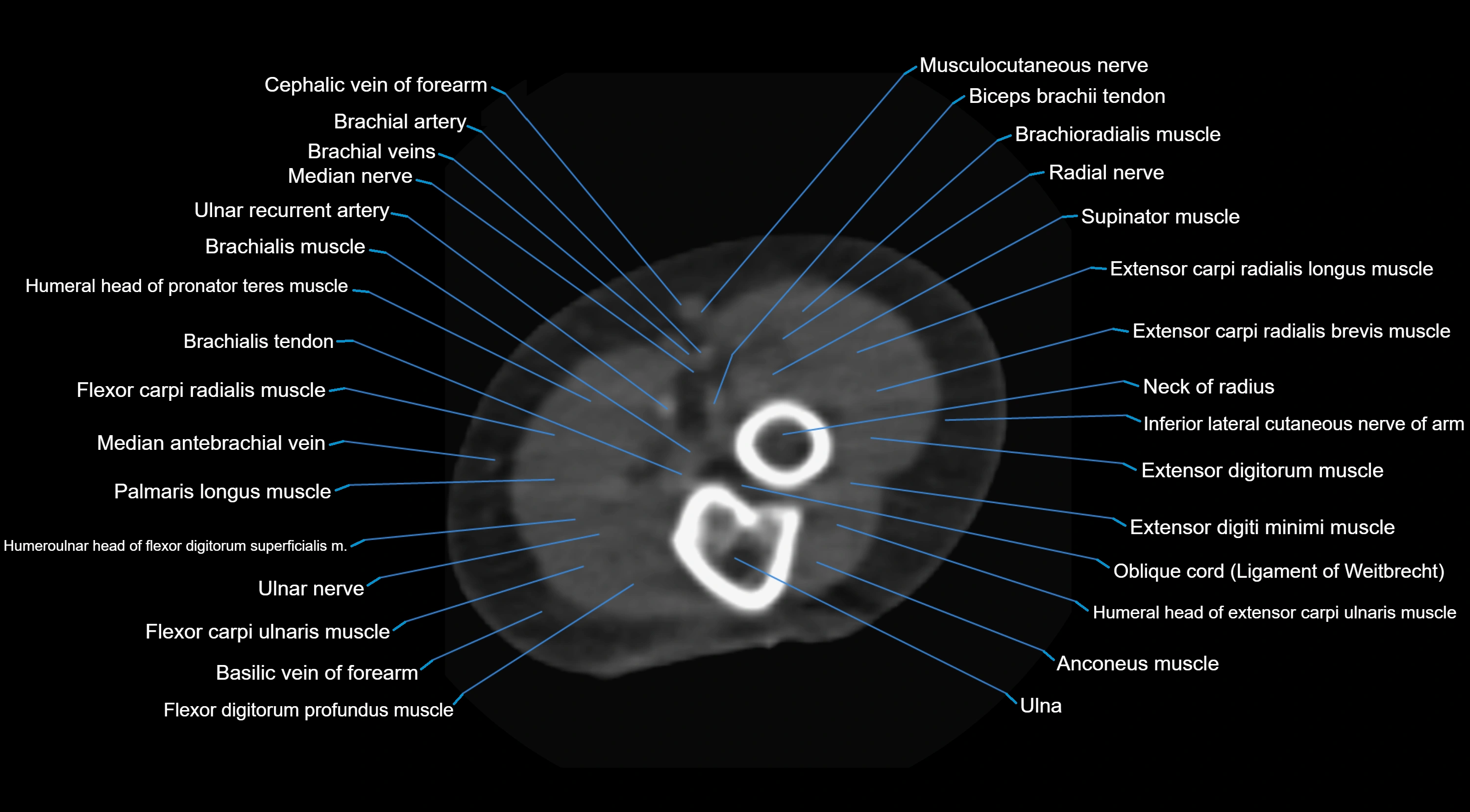 CT elbow axial  cross sectional anatomy labelled  radiology image -00036.webp